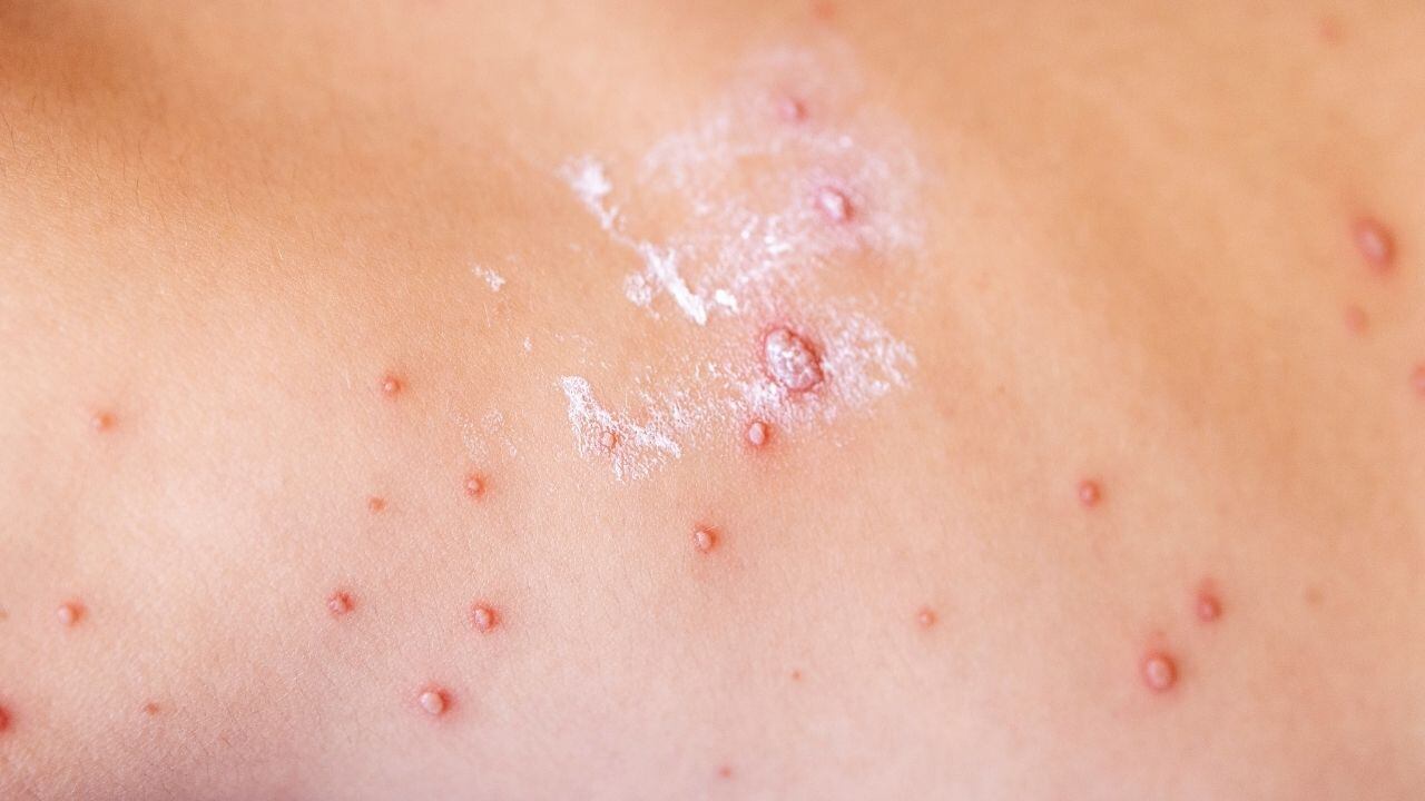 Coahuila, tercer lugar nacional en sarampión epidemia que gobierno minimiza.jpg