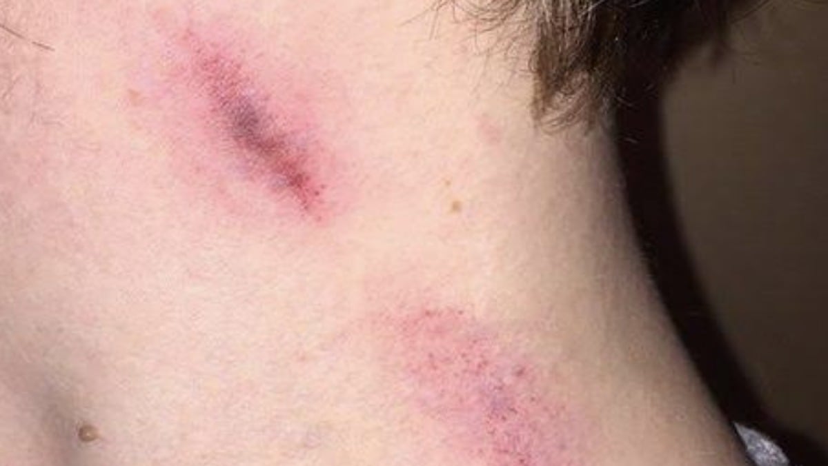 Joven muere al convulsionar y sufrir derrame cerebral tras chupetón.jpeg