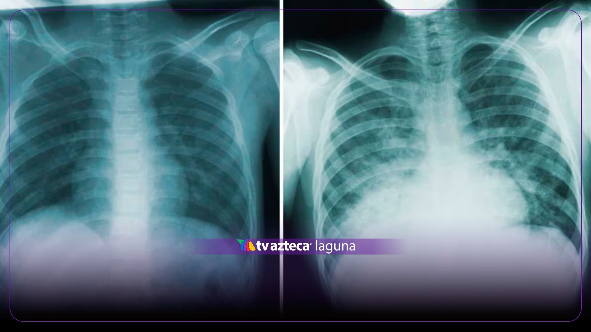 ¡Puede acabar con una vida en 24 horas! Advierten de síntomas y casos extremos de peste neumónica: TODO lo que debes saber